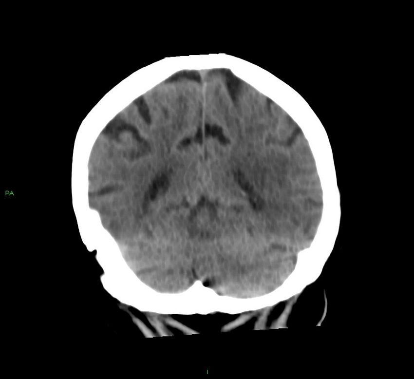 Basal ganglia hemorrhage (Radiopaedia 58790-66024 Coronal non-contrast 17).jpg