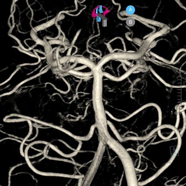 File:Basilar artery perforator aneurysm (Radiopaedia 82455-97734 3D view left VA 42).jpg