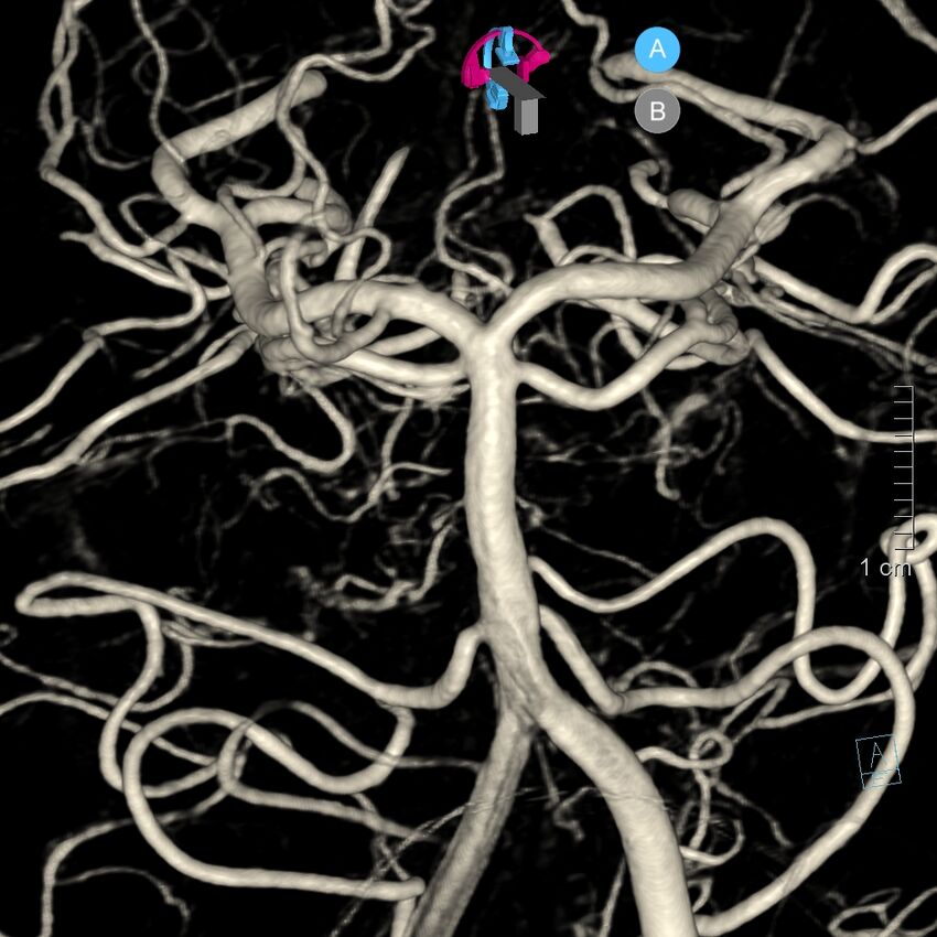 Basilar artery perforator aneurysm (Radiopaedia 82455-97734 3D view left VA 42).jpg