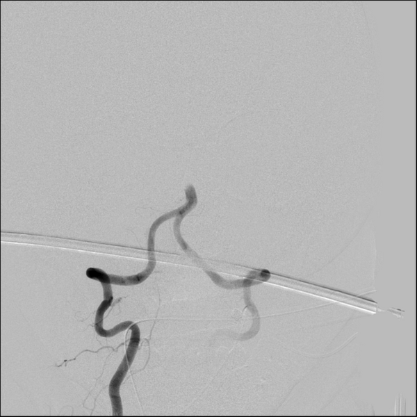 File:Basilar artery thrombosis treated with intra-arterial urokinase (Radiopaedia 34571-35949 A 13).png