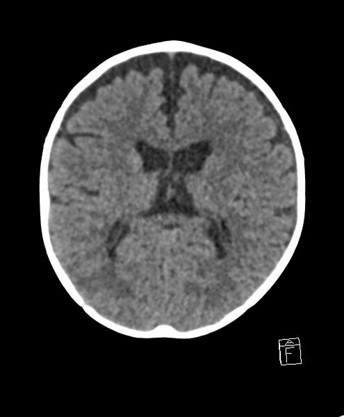 File:Benign enlargement of subarachnoid spaces in infancy (BESS) (Radiopaedia 87459-103795 Axial non-contrast 40).jpg
