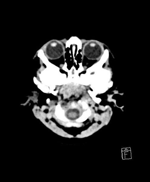 File:Benign enlargement of subarachnoid spaces in infancy (BESS) (Radiopaedia 87459-103795 Axial non-contrast 80).jpg