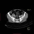 Bifid ureter (Radiopaedia 47604-52253 Axial C+ delayed 22).jpg