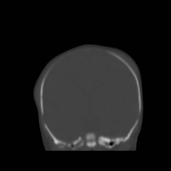 File:Bilateral cephalohematomas and subdural hematomas (Radiopaedia 26778-26929 Coronal bone window 10).jpg