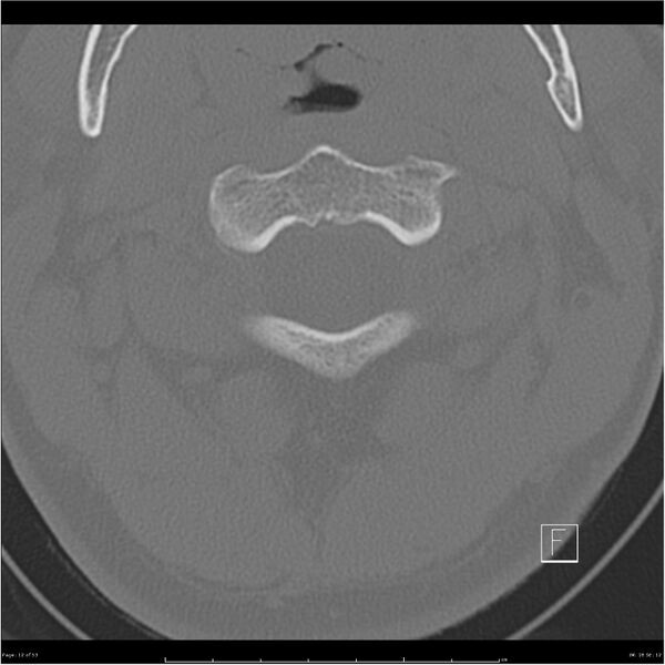 File:Bilateral cervical ribs (Radiopaedia 25868-26017 Axial bone window 12).jpg