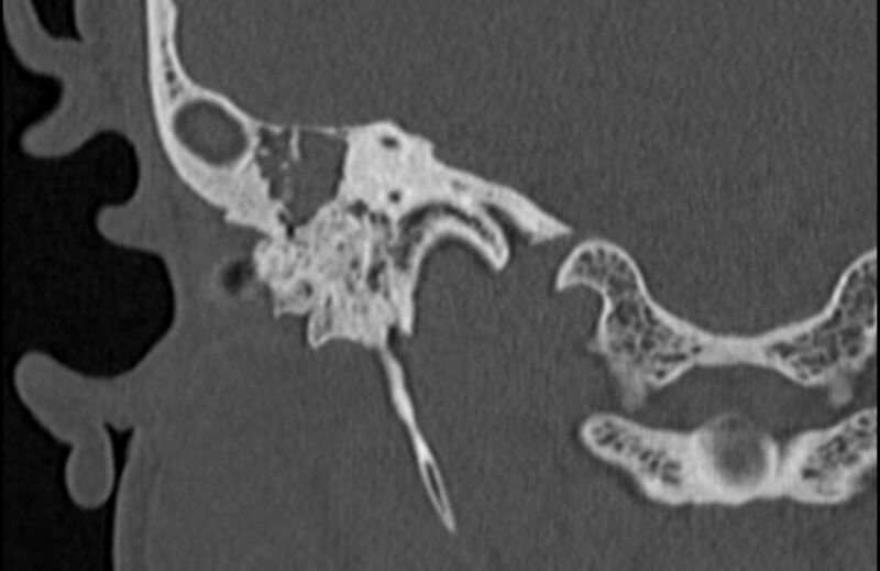 File:Bilateral cholesteatoma (Radiopaedia 54898-61172 Coronal bone window 52).jpg