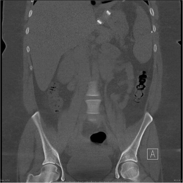 File:Bilateral lumbar ribs (Radiopaedia 25862-26010 Coronal bone window 3).jpg