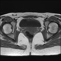 Bilateral ovarian endometriomas (Radiopaedia 87085-103347 Axial T1 16).jpg