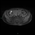 Bilateral ovarian fibroma (Radiopaedia 44568-48293 Axial T1 fat sat 7).jpg