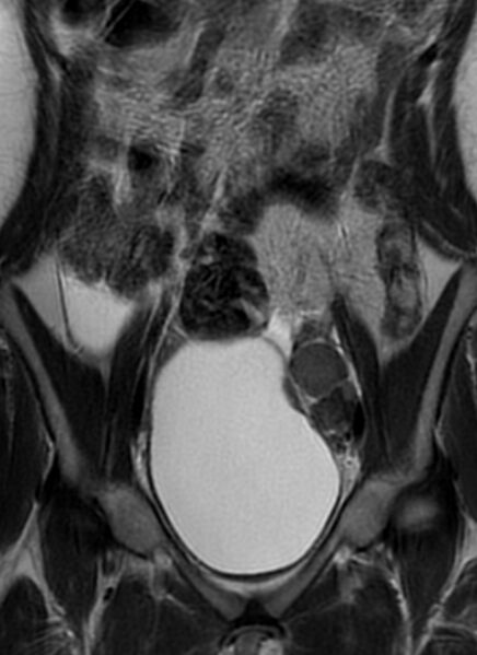 File:Bilateral ovarian fibrothecomas - adolescent (Radiopaedia 86604-102707 Coronal T2 13).jpg