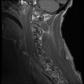 Bilateral perched facets with cord injury (Radiopaedia 45587-49714 Sagittal T1 14).jpg