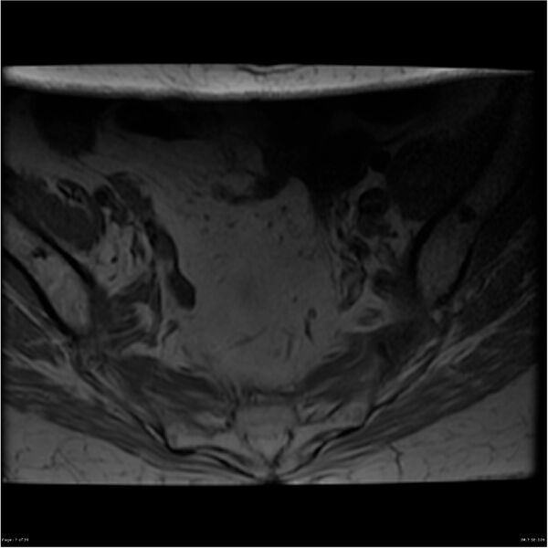 File:Bilateral psoas hematomas (Radiopaedia 24057-24280 T1 7).jpg