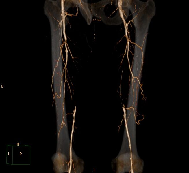 File:Bilateral superficial femoral arterial occlusion (Radiopaedia 25682-25857 3D VR 12).jpg