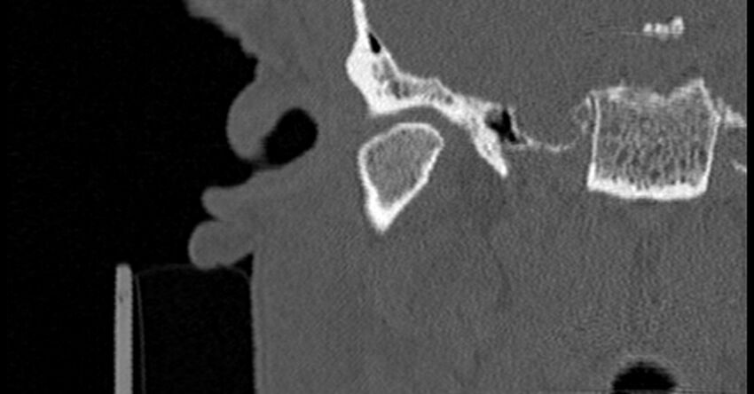 Bilateral temporal bone fractures (Radiopaedia 29482-29970 Coronal non-contrast 61).jpg