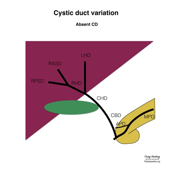File:Biliary duct anatomic variation (diagram) (Radiopaedia 70380-80479 Cystic duct 12).jpeg