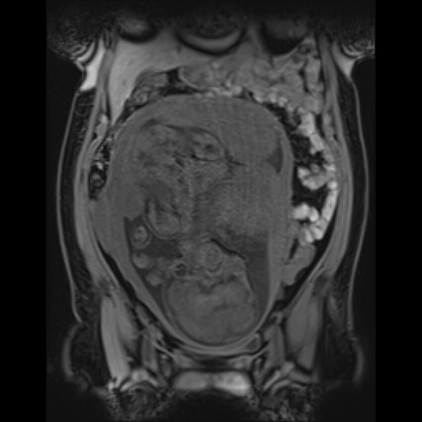 Bilobed placenta accreta (Radiopaedia 69648-79591 Coronal T1 vibe 66).jpg