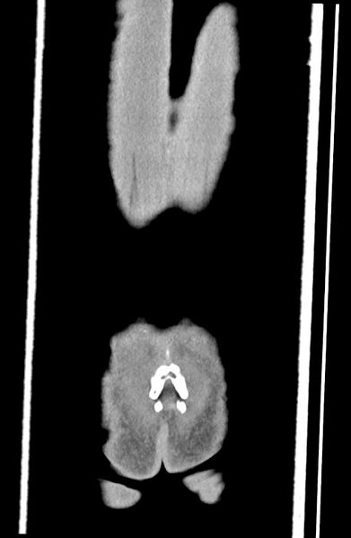 File:Blunt injury to the small bowel (Radiopaedia 74953-85987 B 94).jpg