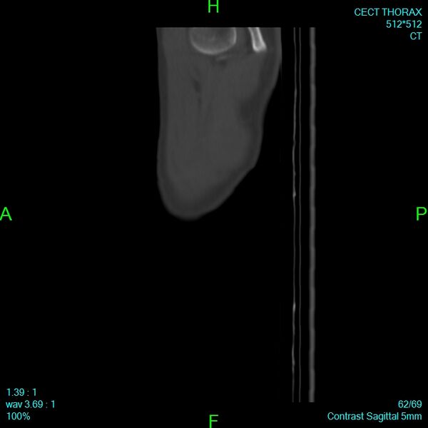 File:Bone metastases from lung carcinoma (Radiopaedia 54703-60937 Sagittal bone window 62).jpg