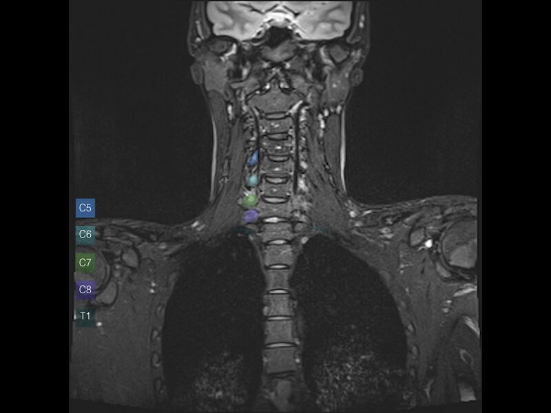 File:Brachial plexus anatomy (Radiopaedia 64414-73226 Coronal STIR 3).jpeg