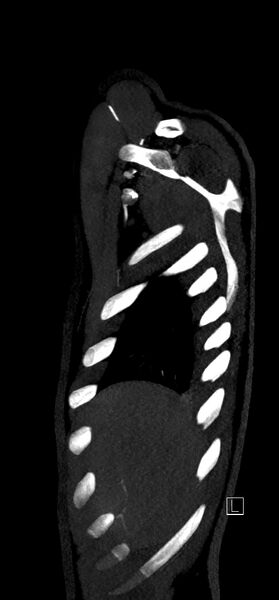 File:Brachiocephalic trunk pseudoaneurysm (Radiopaedia 70978-81191 C 11).jpg