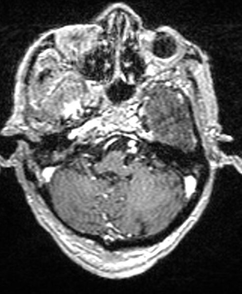 File:Brain abscess with dual rim sign (Radiopaedia 87566-103938 Axial T1 C+ 41).jpg
