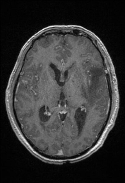 File:Brain abscess with ventriculitis (Radiopaedia 85703-101495 Axial T1 C+ 92).jpg