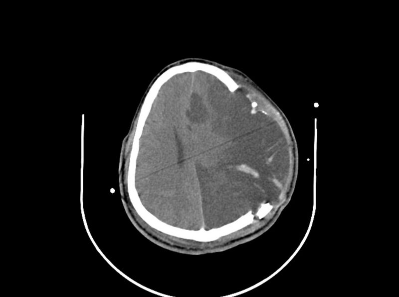 File:Brain injury by firearm projectile (Radiopaedia 82068-96087 B 130).jpg