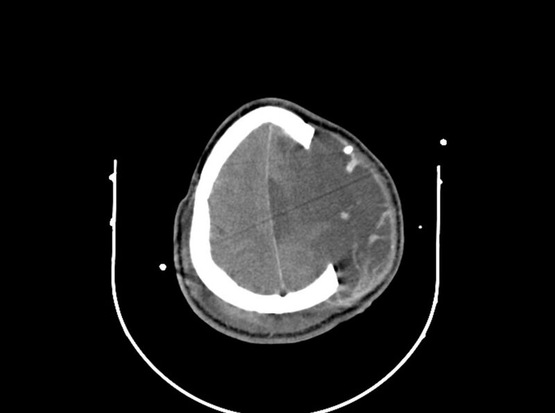 File:Brain injury by firearm projectile (Radiopaedia 82068-96087 B 152).jpg
