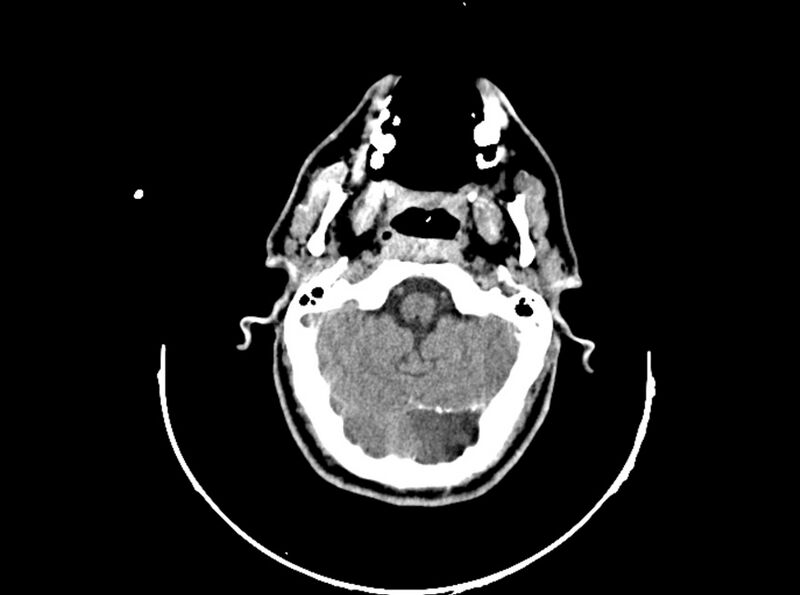 File:Brain injury by firearm projectile (Radiopaedia 82068-96088 A 70).jpg