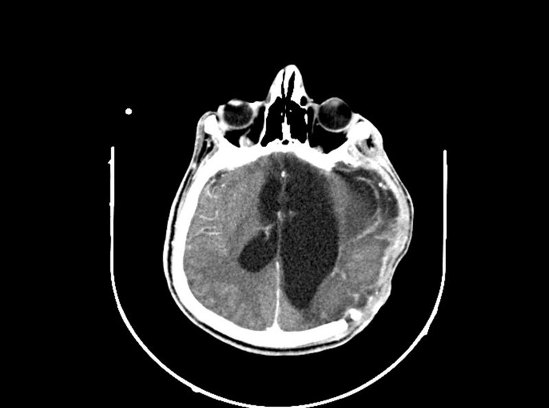 File:Brain injury by firearm projectile (Radiopaedia 82068-96088 B 133).jpg