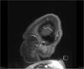 Brainstem glioma (Radiopaedia 21819-21775 D 1).jpg