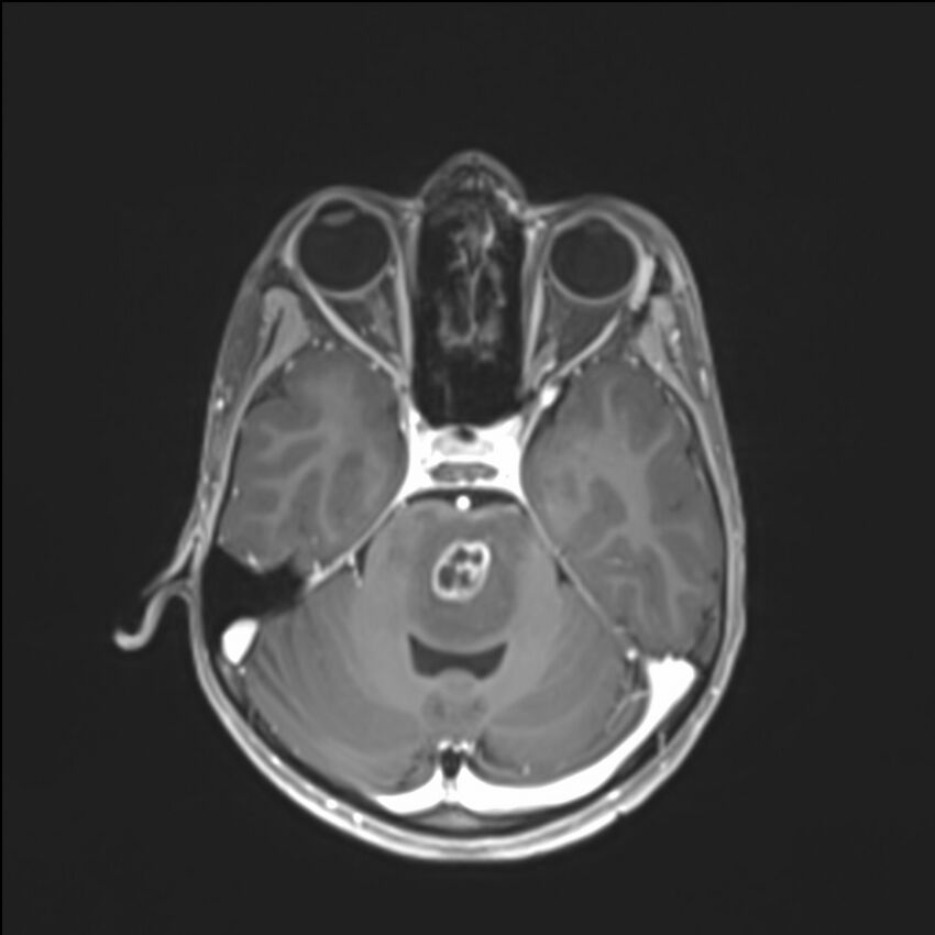 Brainstem glioma (Radiopaedia 70548-80674 Axial T1 C+ 53).jpg