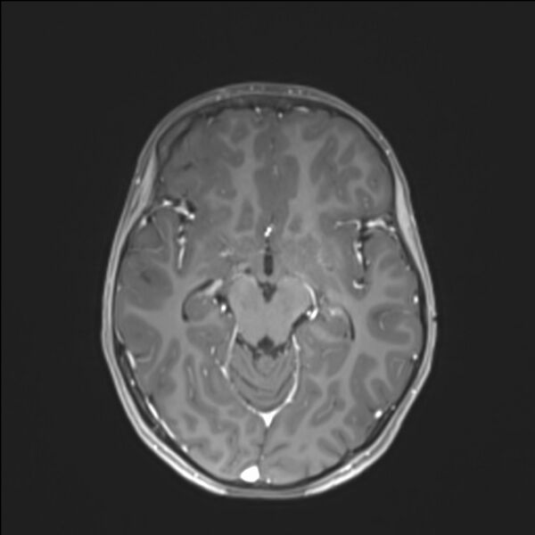 File:Brainstem glioma (Radiopaedia 70548-80674 Axial T1 C+ 71).jpg