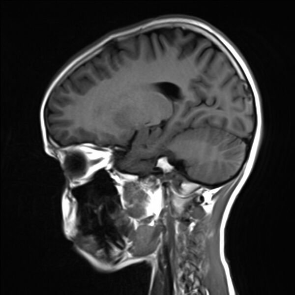 File:Brainstem glioma (Radiopaedia 70548-80674 Sagittal T1 16).jpg