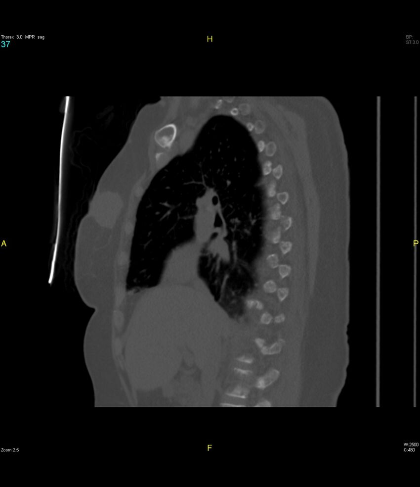 Breast primary with lung and bone metastases (Radiopaedia 40620-43228 Sagittal bone window 37).jpg