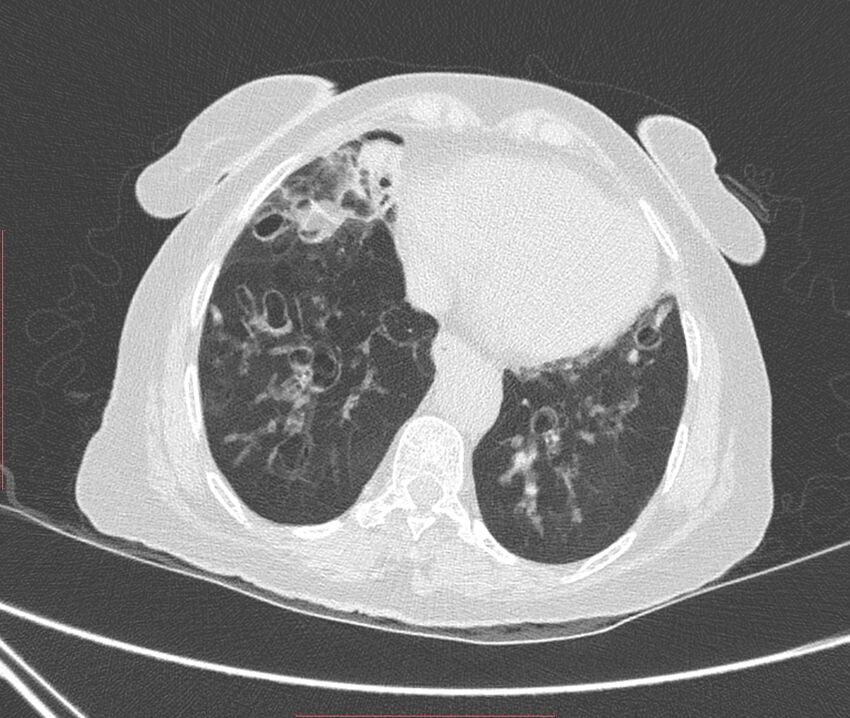 Bronchiectasis (Radiopaedia 72693-83293 Axial lung window 100).jpg