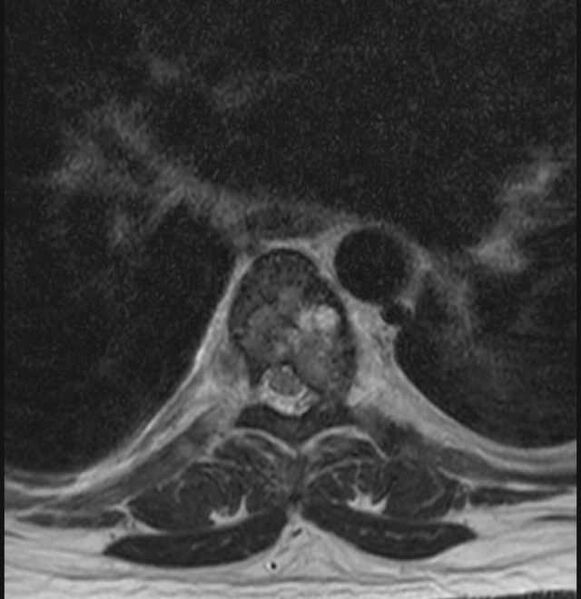 File:Brown tumors compressing the spinal cord (Radiopaedia 68442-78030 A 31).jpg