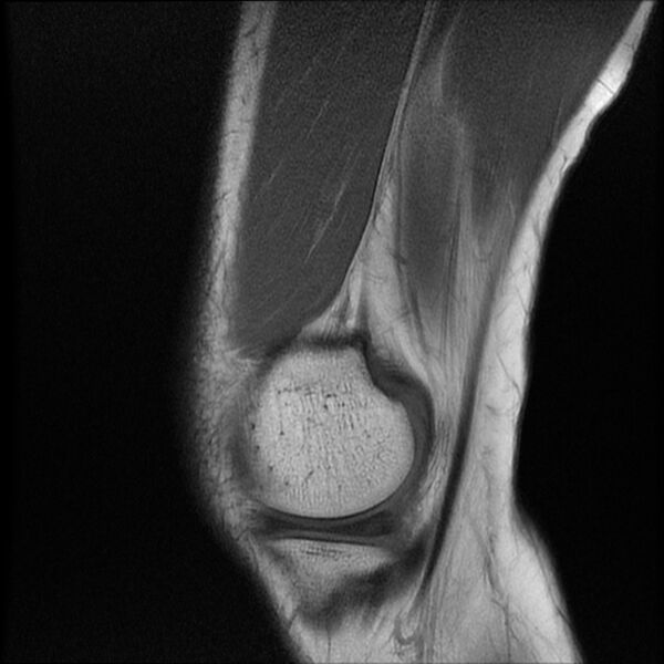 File:Bucket-handle meniscus tear (Radiopaedia 65700-74809 Sagittal T1 5).jpg