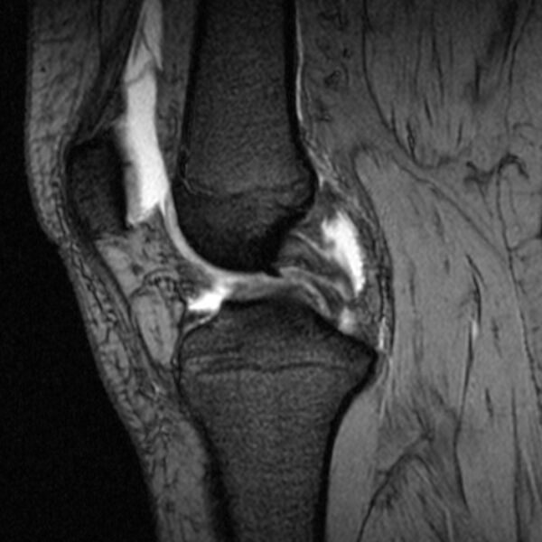 File:Bucket handle tear - medial meniscus (Radiopaedia 79028-91942 D 14).jpg