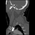 C1 anterior arch (plough) fracture - type 1 (Radiopaedia 76181-87720 Sagittal bone window 23).jpg