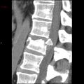 Calcaneal fracture and associated spinal injury (Radiopaedia 17896-17658 E 1).jpg