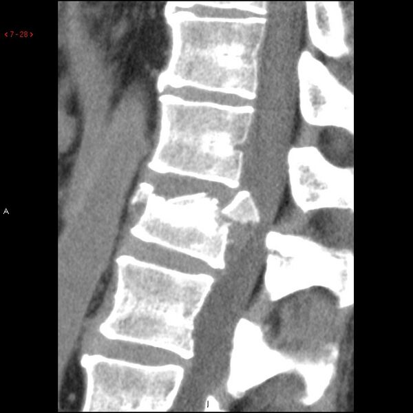 File:Calcaneal fracture and associated spinal injury (Radiopaedia 17896-17658 E 1).jpg
