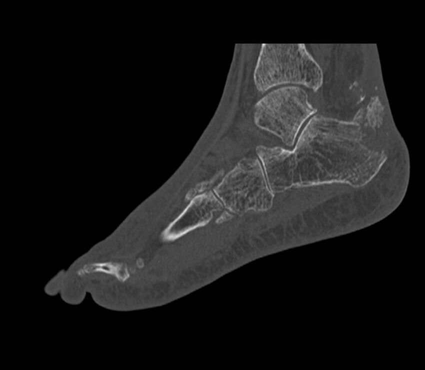 Calcaneal tuberosity avulsion fracture (Radiopaedia 22649-22668 Sagittal bone window 16).jpg