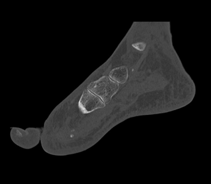 File:Calcaneal tuberosity avulsion fracture (Radiopaedia 22649-22668 Sagittal bone window 38).jpg