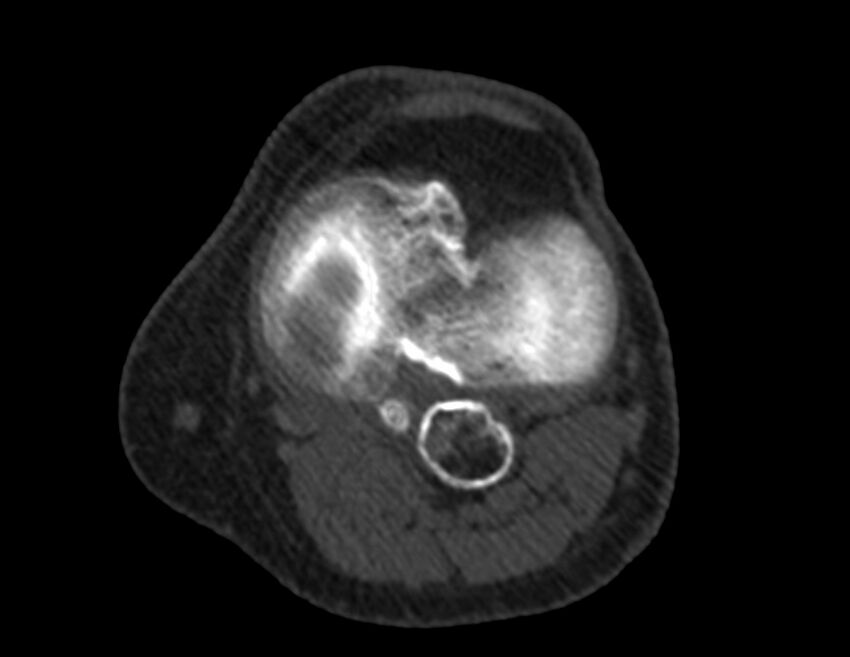 Calcified hematoma - popliteal fossa (Radiopaedia 63938-72763 Axial bone window 31).jpg