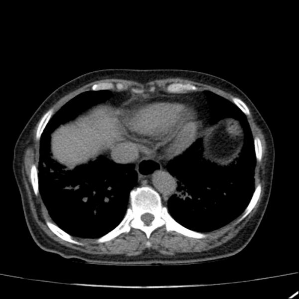 File:Calcified hepatic hydatid cyst (Radiopaedia 26872-27046 Axial non-contrast 11).jpg