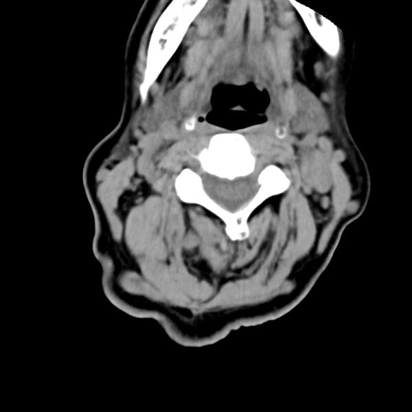 File:Calcified meningioma - cervical canal (Radiopaedia 70136-80171 B 15).jpg