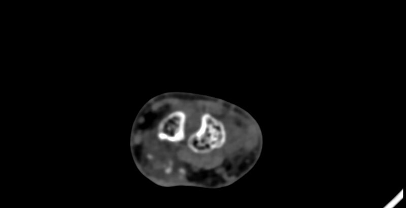 File:Calcifying aponeurotic fibroma (Radiopaedia 88423-105064 B 56).jpg