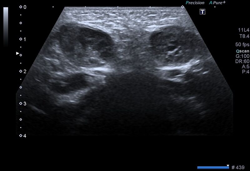 File:Canal of Nuck hernia - bilateral ovaries (Radiopaedia 57930-64900 B 1).jpg