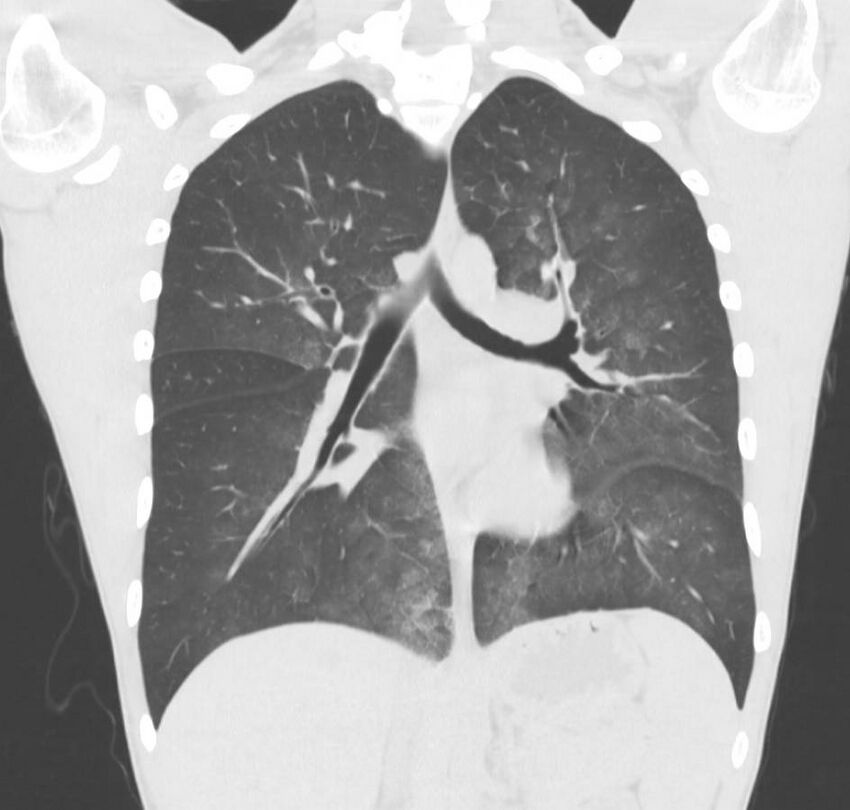 Cannabis-induced diffuse alveolar hemorrhage (Radiopaedia 89834-106946 Coronal lung window 41).jpg